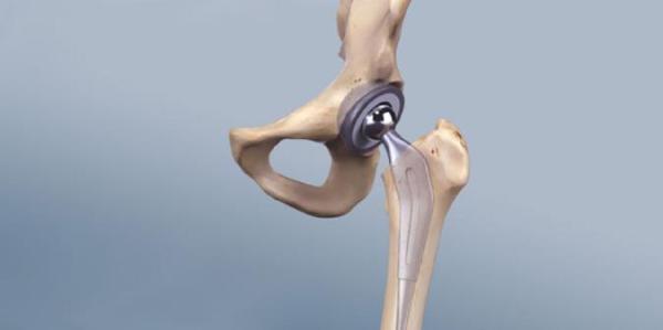 عمل جراحی تعویض مفصل لگن و ران چیست و چگونه انجام میشود