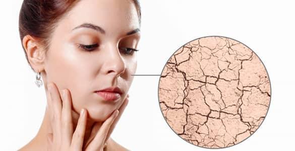 علل و روش های موثر خانگی برای درمان خشکی پوست صورت