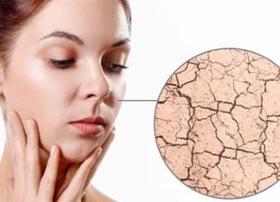 علل و روش های موثر خانگی برای درمان خشکی پوست صورت